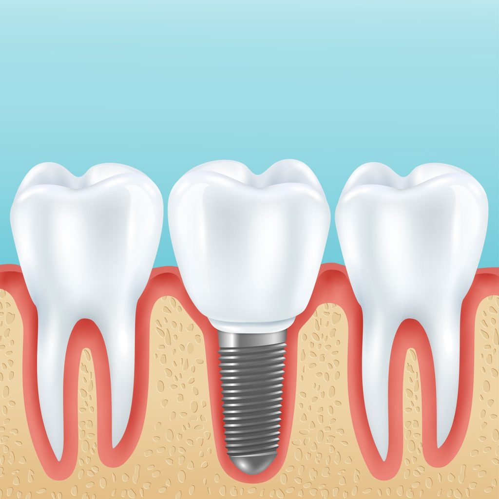 diş implantı