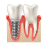 implant
